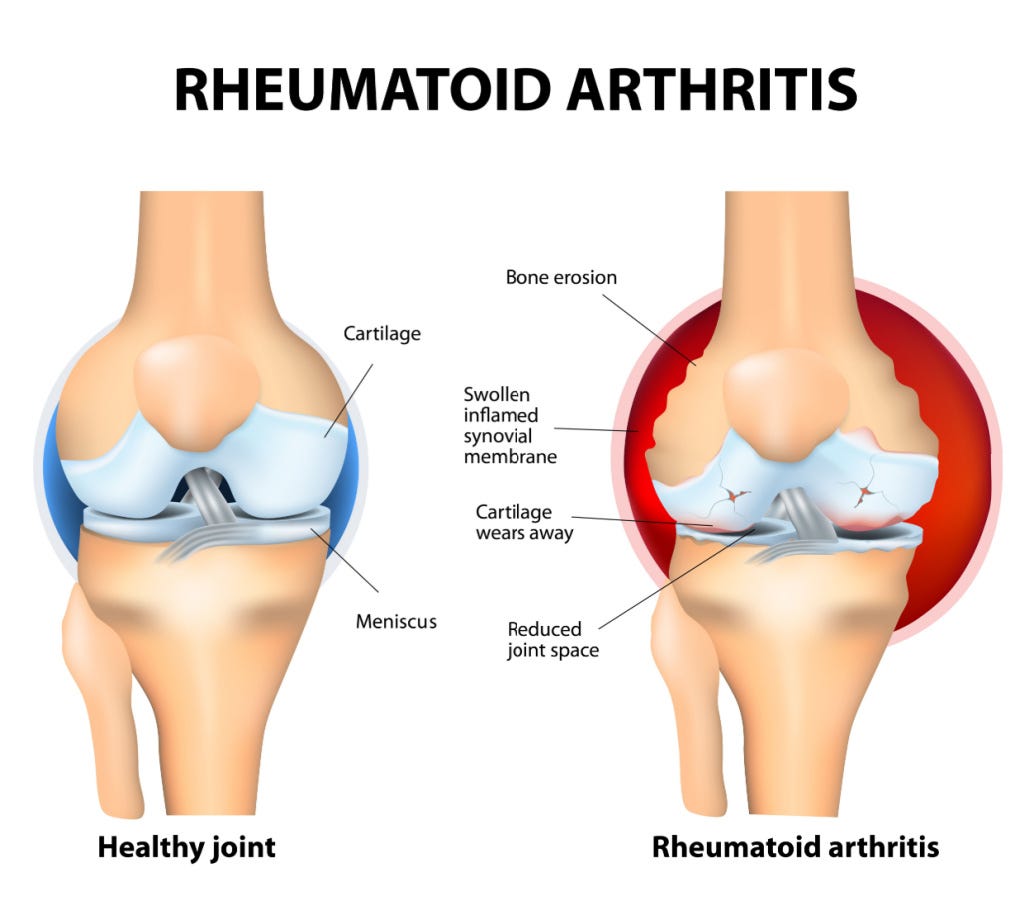 diagram of rheumatoid arthritis in knees